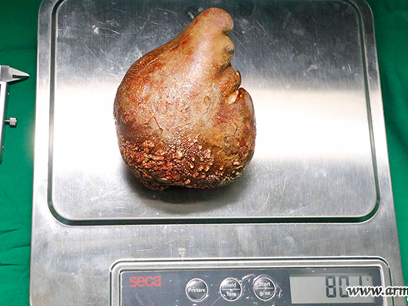 Sri Lanka Kidney Stone to Guinness World Record